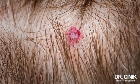 Scabs And Soreness On The Scalp 111 Reasons