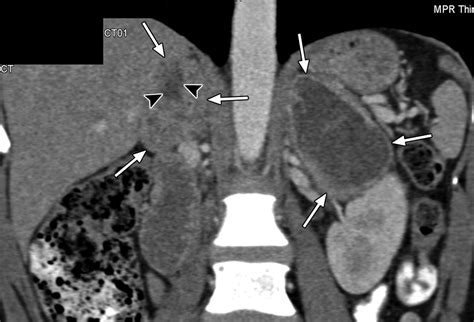 Adrenal Mass Imaging With Multidetector Ct Pathologic Conditions
