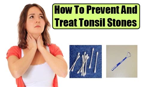 The Most Effective Tonsil Stones Treatment Tonsil Stones