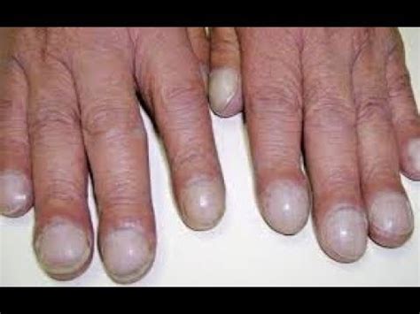 Lung cancer doesn't always cause symptoms in its early stages. Lung Cancer Symptoms - YouTube