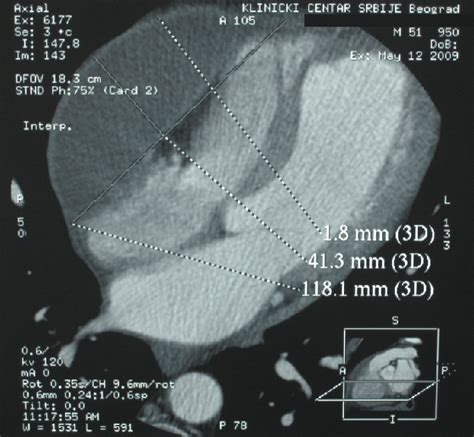 It is usually symptomatic and is commonly associated with a malignant cause.20 the diagnosis of a malignant pleural effusion is discussed in the guideline on the investigation of a unilateral pleural effusion. COMPUTED TOMOGRAPHY DEMONSTRATING A LARGE LOCULATED POST ...