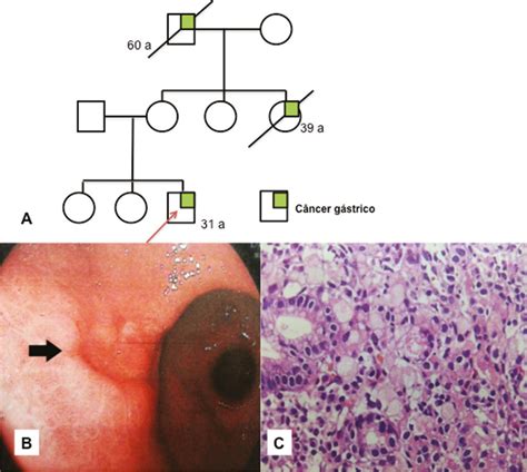 Scielo Brasil Hereditary Diffuse Gastric Cancer Laparoscopic