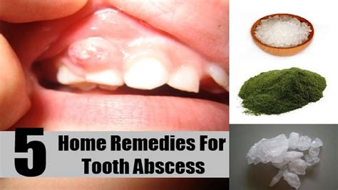 Abscessed Tooth Home Remedy Homemade Ftempo