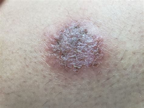 O Que é E O Que Causa Eczema Numular Prontopele