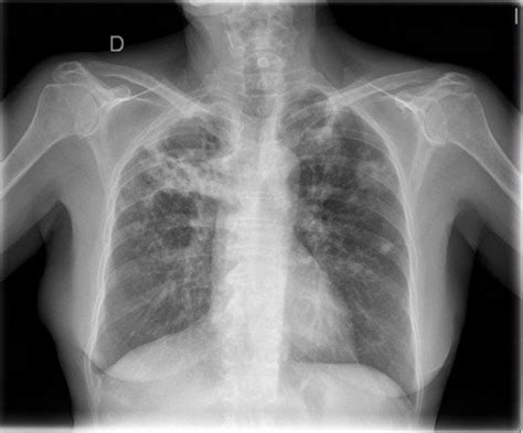 Radiografia Tuberculosis The Best Porn Website