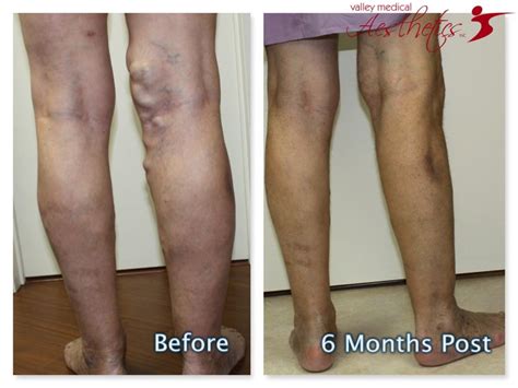 Pin On Evlt Varicose Vein Treatment Results