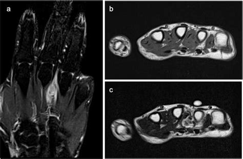 Recurrent Synovial Sarcoma In The Dorsum Of The Hand Case 5 A Mri