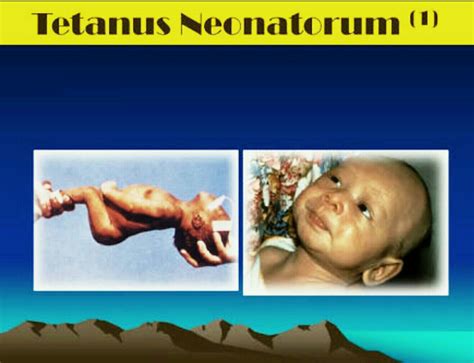Bahaya Tetanus Neonatorum Pada Bayi Atmago
