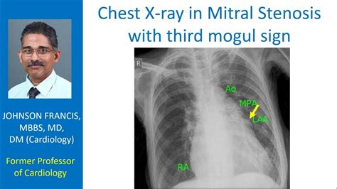 Chest X Ray In Mitral Stenosis With Third Mogul Sign Youtube