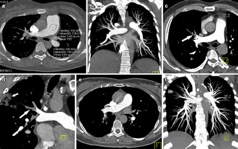 Comparison Of 70 80 And 100 Kvp Ct Pulmonary Angiography In Three
