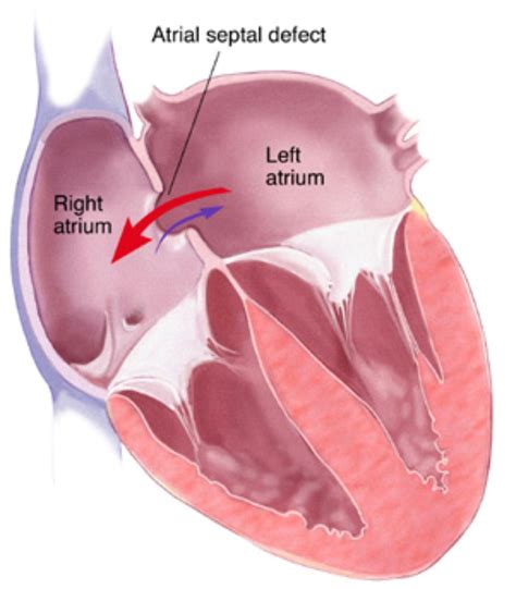 Atrial Septal Defect Congenital Heart Condition