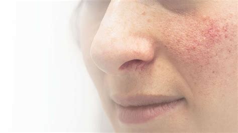 Facial Red Spot Treatment New York Ny Laser Center
