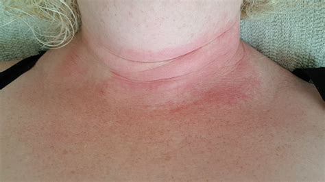 Eczema On Neck And Chest