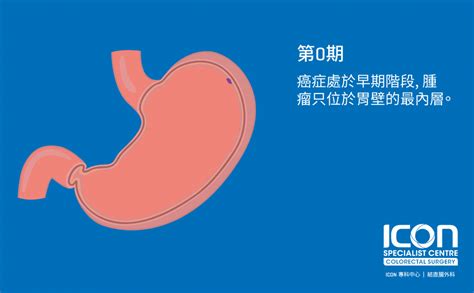 根據行政院衛生署十年來的統計，癌症已超過腦血管疾病，居十大死亡原因的第一位，其中胃癌僅次於肝癌、肺癌及結直腸癌居第四位。 民國 85年，台灣死於胃癌的人數為 2519人，其中男性有 1712人. 胃癌 — ICON專科中心