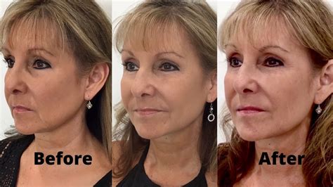 How To Get Rid Of Jowls With Dermal Fillers Step 3 Youtube
