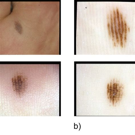 Examples Of Dermoscopic Images Showing Acral Melanocytic Lesions