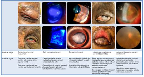 Herpes zoster is more common in adults, especially the elderly, the unwell, and the immunosuppressed. Spectrum of ocular complications of herpes zoster ...