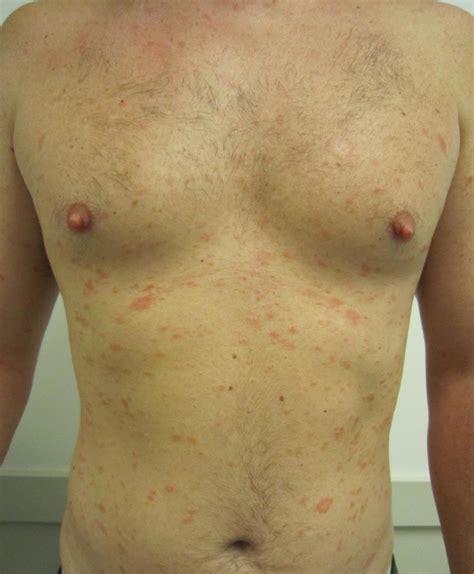 The united states national library of medicine. Pityriasis Rosea - Dermatology - Medbullets Step 2/3