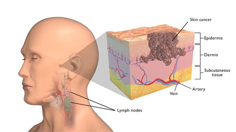 Skin Cancer On The Face Head And Neck Cancer Australia