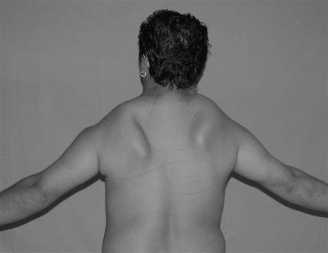 Fixation Of Winged Scapula In Facioscapulohumeral Muscular Dystrophy