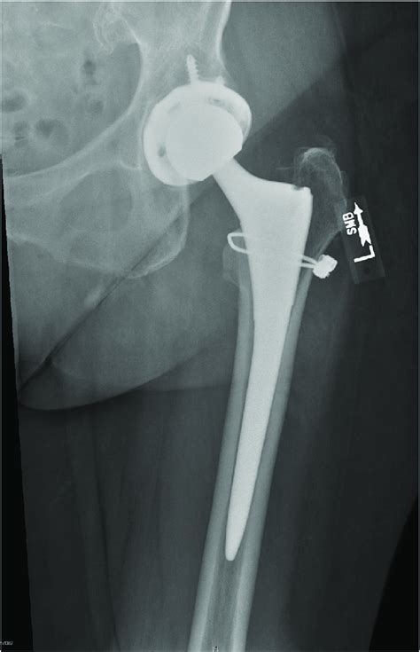 Cementless Total Hip Arthroplasty With Prophylactic Femoral Cable
