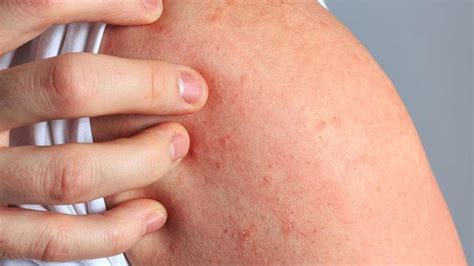 Scabies Symptoms And Causes Page 2 Entirely Health