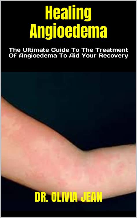 Healing Angioedema The Ultimate Guide To The Treatment Of Angioedema