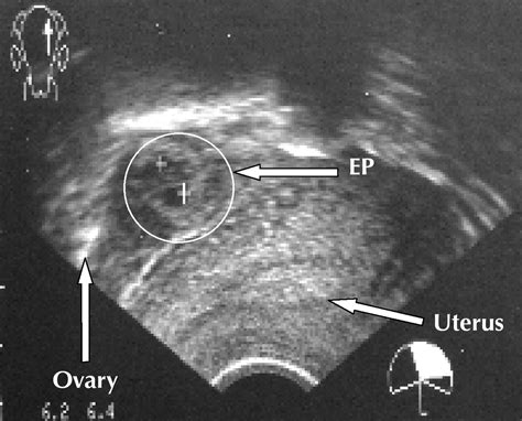 Diagnosis And Treatment Of Ectopic Pregnancy Cmaj