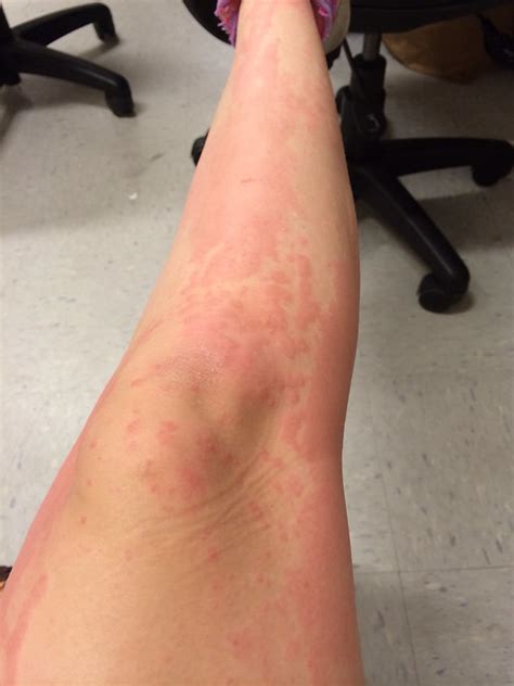 Hives Hive Hivegate Skin Hospital Allergic Allergy Reaction Flickr