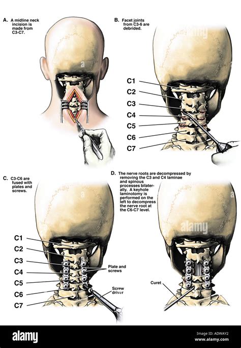 C3 C4 Laminectomies Cervical Posterior C6 7 Laminotomy Y Spin