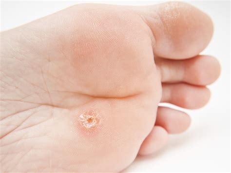 Callus Under Foot Goodskin Dermatology