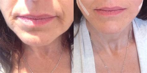 Before And After 4 Point Lift Using Pdo Threads Thread Lift Neck