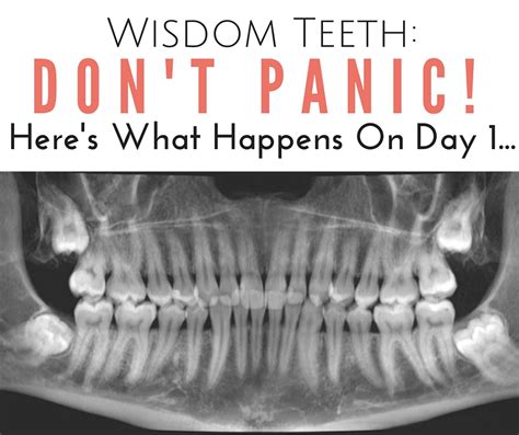 Check spelling or type a new query. Wisdom Teeth: Don't Panic! Here's What Happens On Day 1 ...