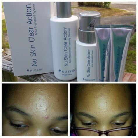 Help Clear Up Acne Using Nu Skin Clear Action Acne Medication System