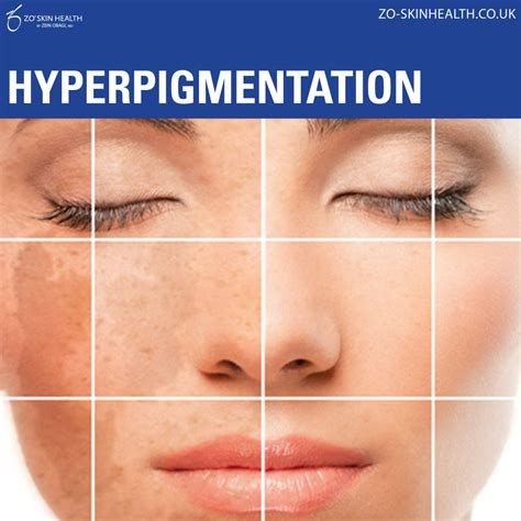 Red Hyperpigmentation Causes Treatments And More Justinboey