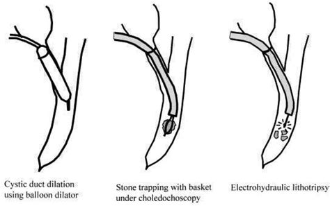 Laparoscopic Management Of Common Bile Duct Stones Transcystic