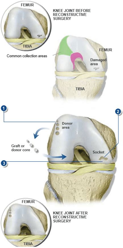 Knee Cartilage Replacement Surgery Dr Patrick Chin Orthopedic