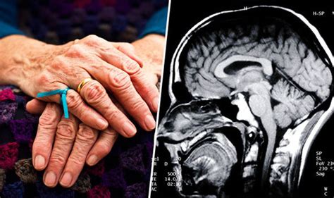 Scientists Spot Dementia Dagger In Brain Scan That Can Diagnose