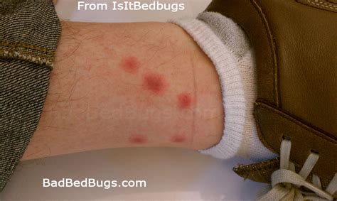 Bedbug Bites Discussion Pg 1