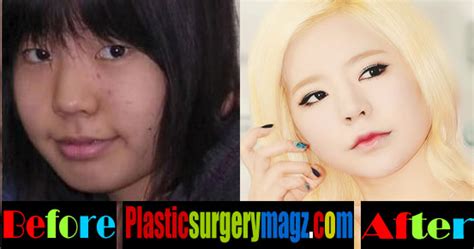 Sunny Girls Generation Plastic Surgery Before And After Plastic Surgery Magazine