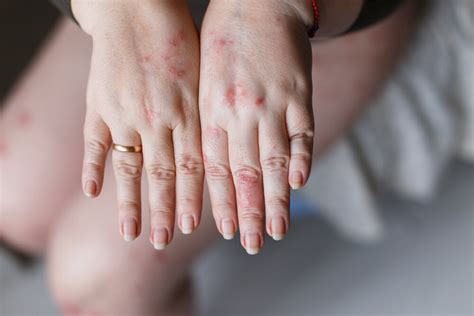 Psoriasis Vs Eczema Lets Understand The Difference