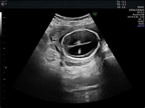 Fetal Hydrocephalus Ultrasound