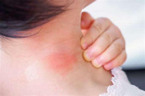 Home Remedies For Insect Bites And Stings
