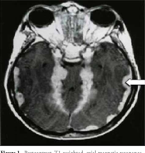 Figure 1 From Rosai Dorfman Disease With Central Nervous System
