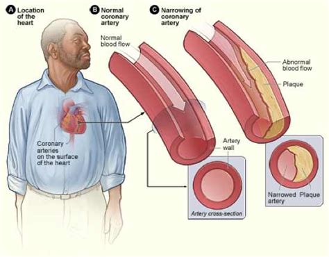 The earlier the condition is diagnosed, the sooner treatment can begin. Heart disease - causes, symptoms and treatment | Health ...