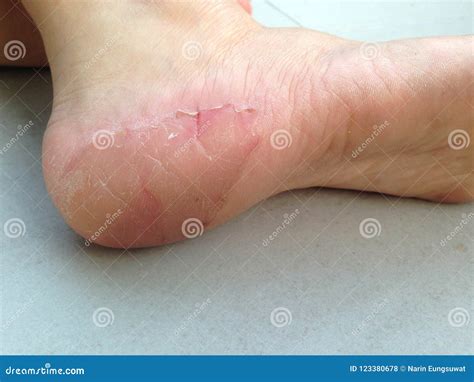 The Skin Heels Peel Off Stock Photo Image Of Cuticle 123380678