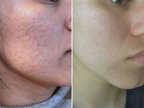 Getting Rid Of Acne Scars With Microneedling Raw Beauty Medical Spa