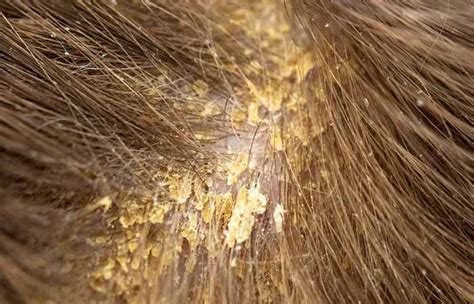 Dandruff is not a serious medical condition and is relatively easy to treat. How To Tell The Difference Between Psoriasis And Eczema On ...