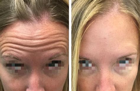 The first thing you'll notice immediately after botox injections are little bumps and dots of blood that look just like mosquito. Revive At The Group › Dysport > Improve Frown Lines