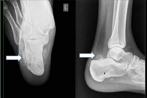 Lateral Radiograph Of Foot Shows Ill Defined Heterogeneous Sclerotic